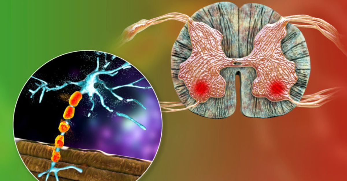 Primary Lateral Sclerosis (PLS) – Symptoms, Causes And Treatment