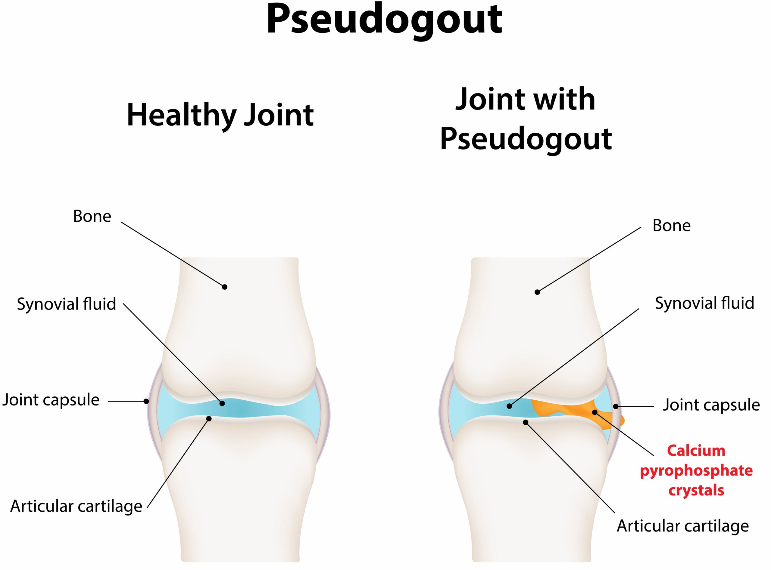 Pseudogout – Symptomsc Causes And Treatment