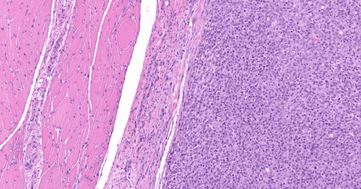 Síntomas y causas del rabdomiosarcoma - Blog de Apollo Hospitals