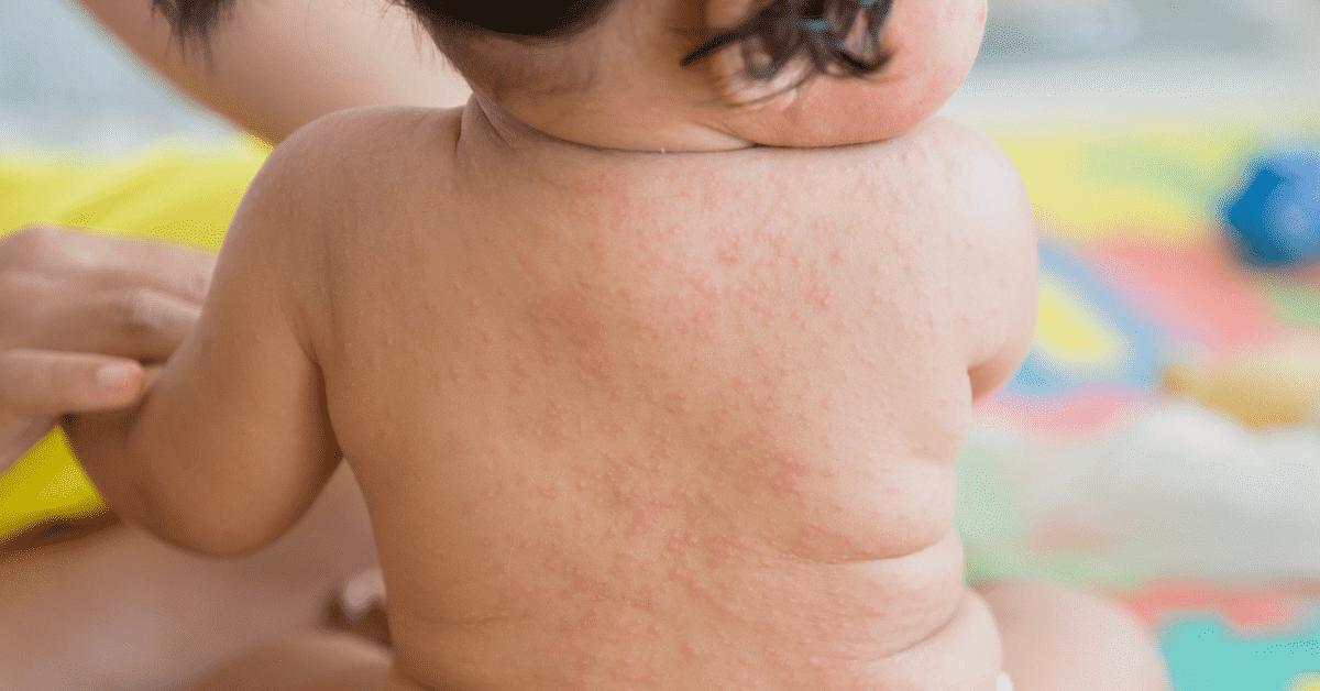 Roseola Infantum: Symptoms, Treatment and More