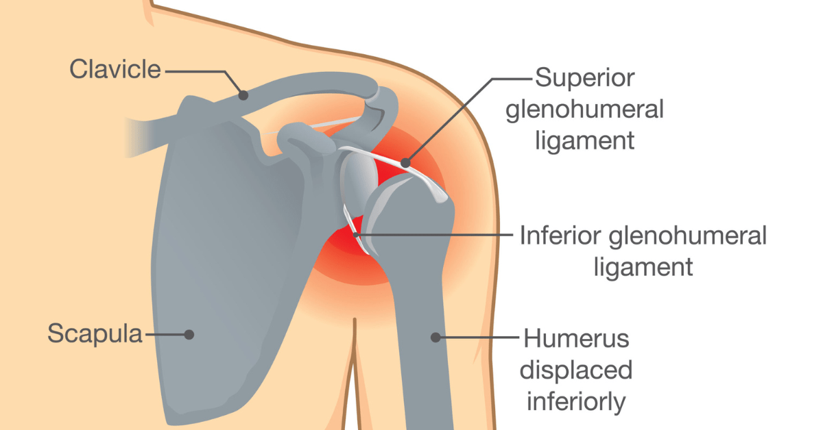 Separated Shoulder – Causes, Symptoms, Types and Treatment