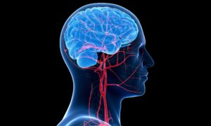 What’s the connection between diabetes and stroke?