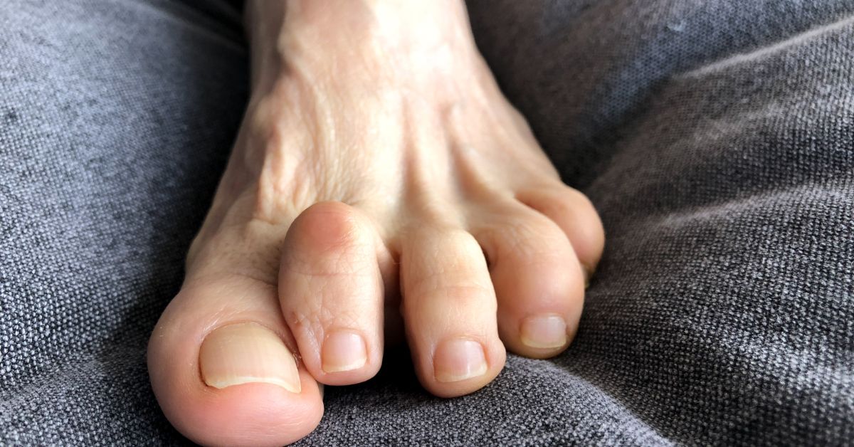 Hammer Toe: Causes, Symptoms, and Diagnosis