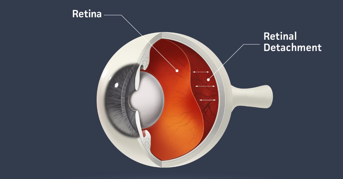 Retinal Detachment – Causes, Symptoms and Treatment