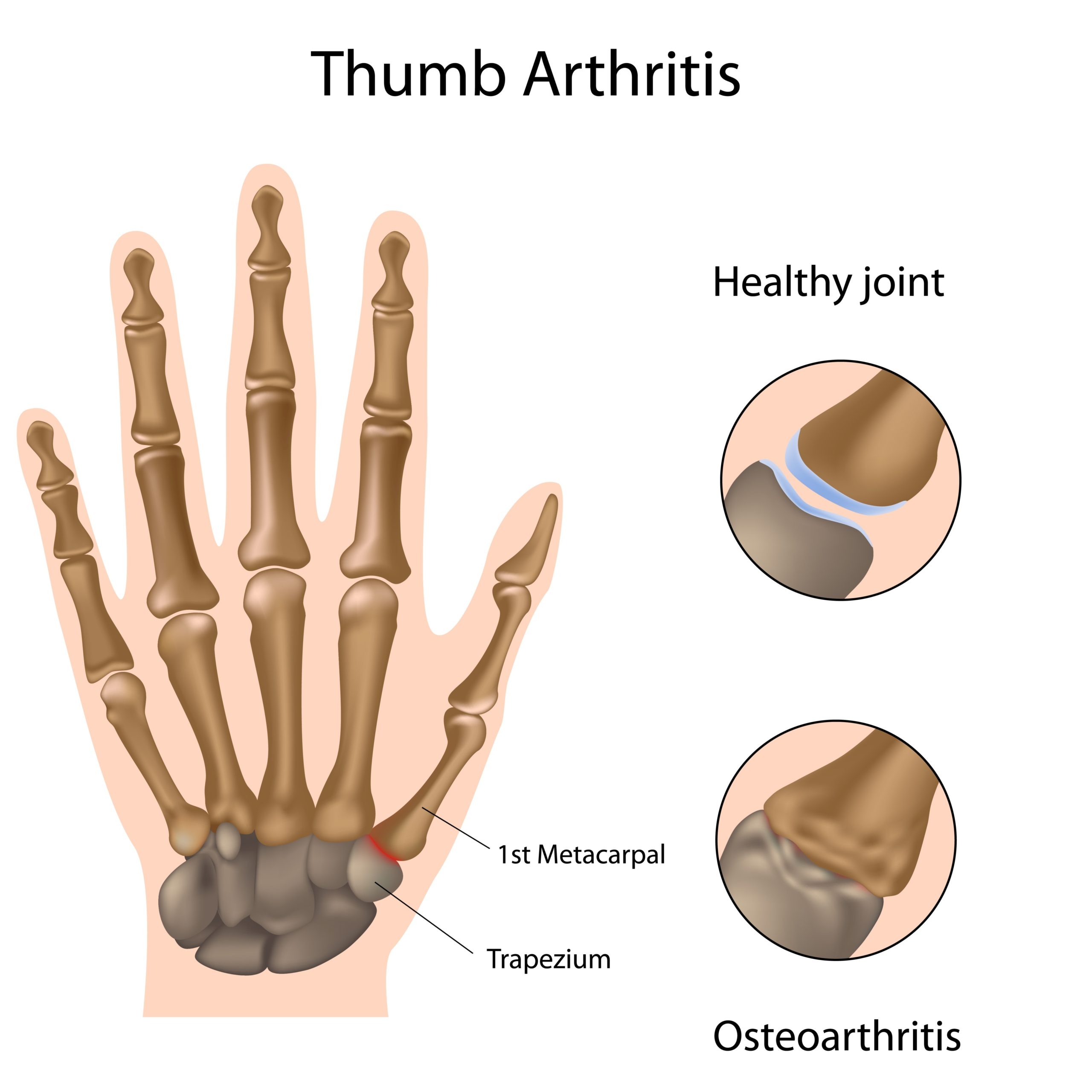 Thumb Arthritis – Causes, Symptoms and Treatment