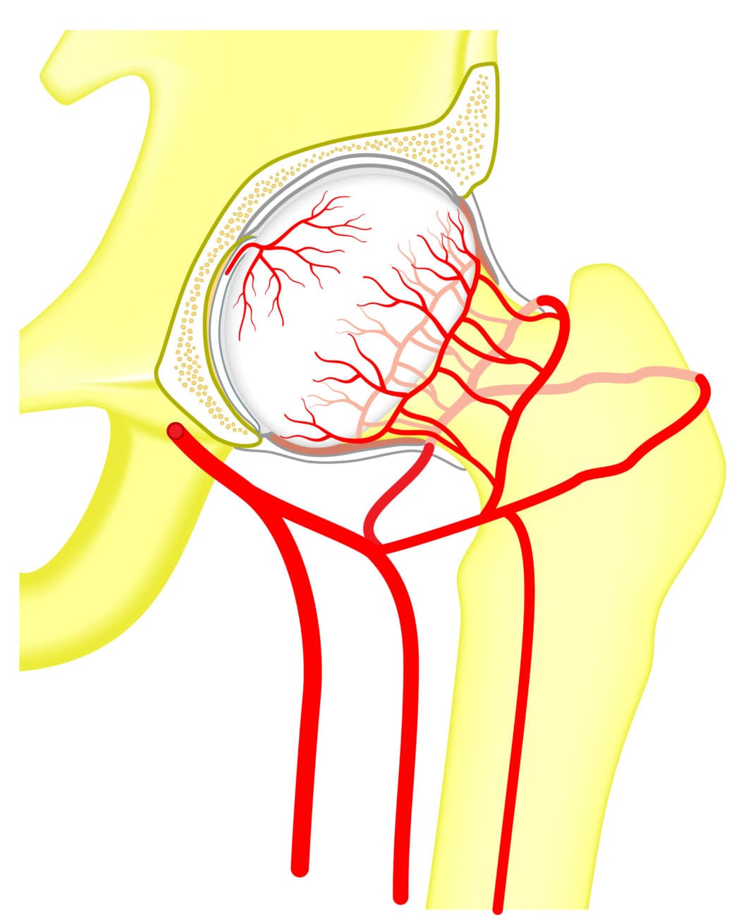 Avascular Necrosis (Osteonecrosis) – Symptoms, Causes And Treatment