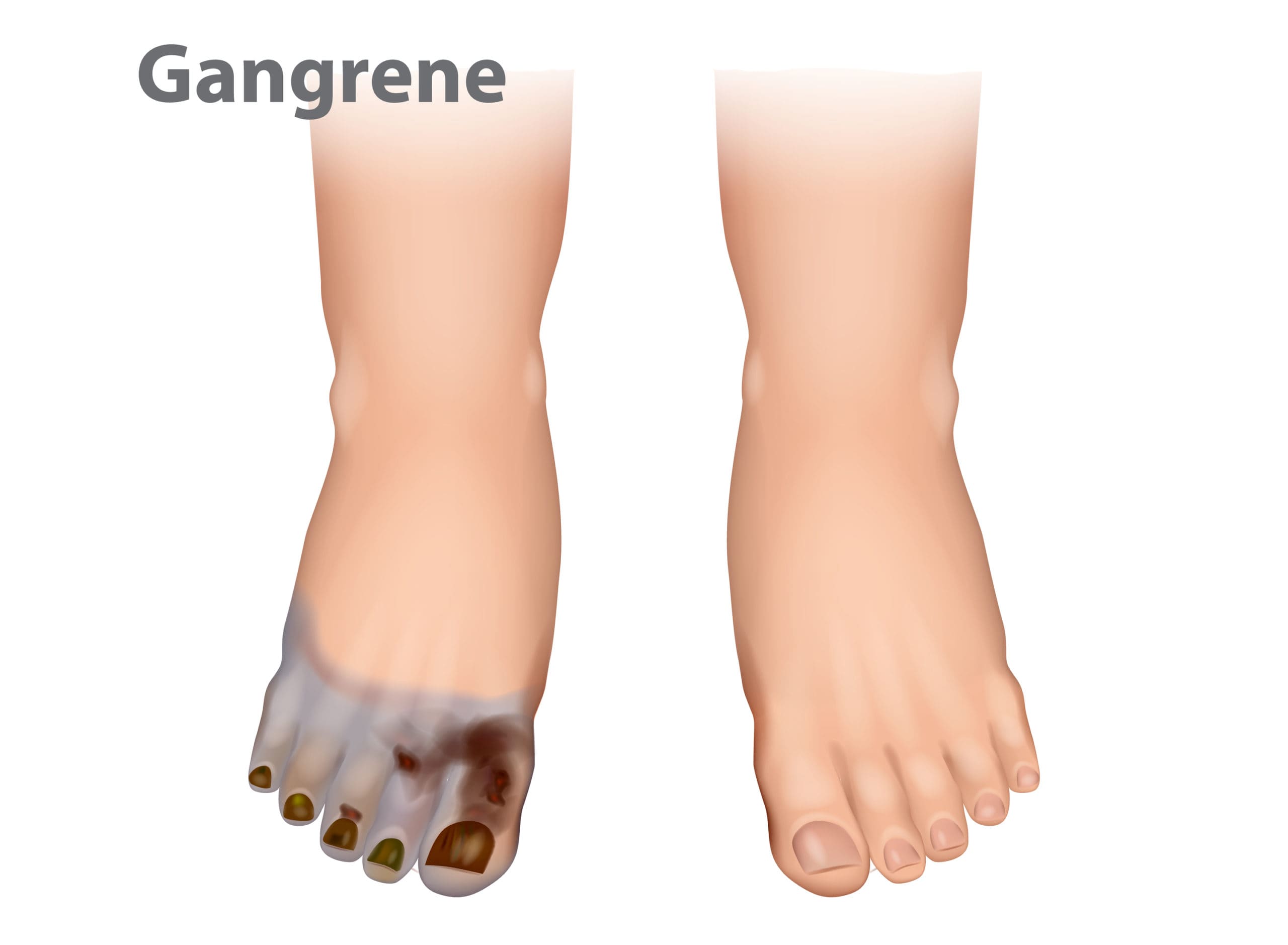 Gangrene -Types, Causes and Symptoms - Apollo Hospital Blog