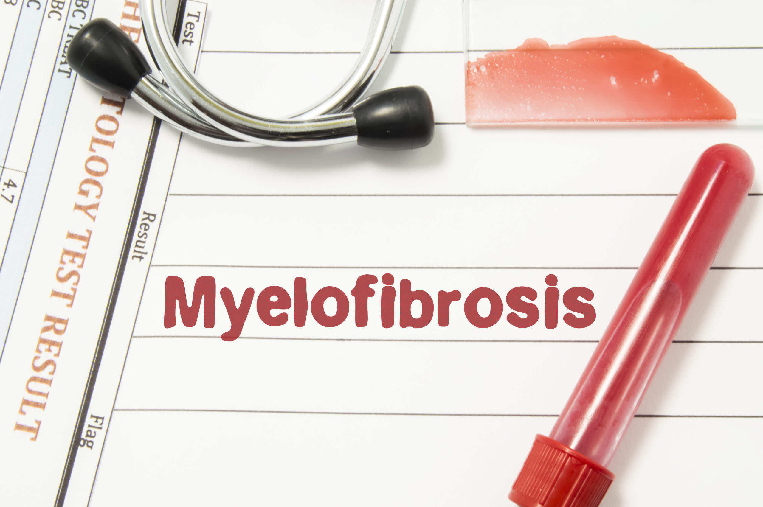 Myelofibrosis; Causes, Symptoms & Treatment