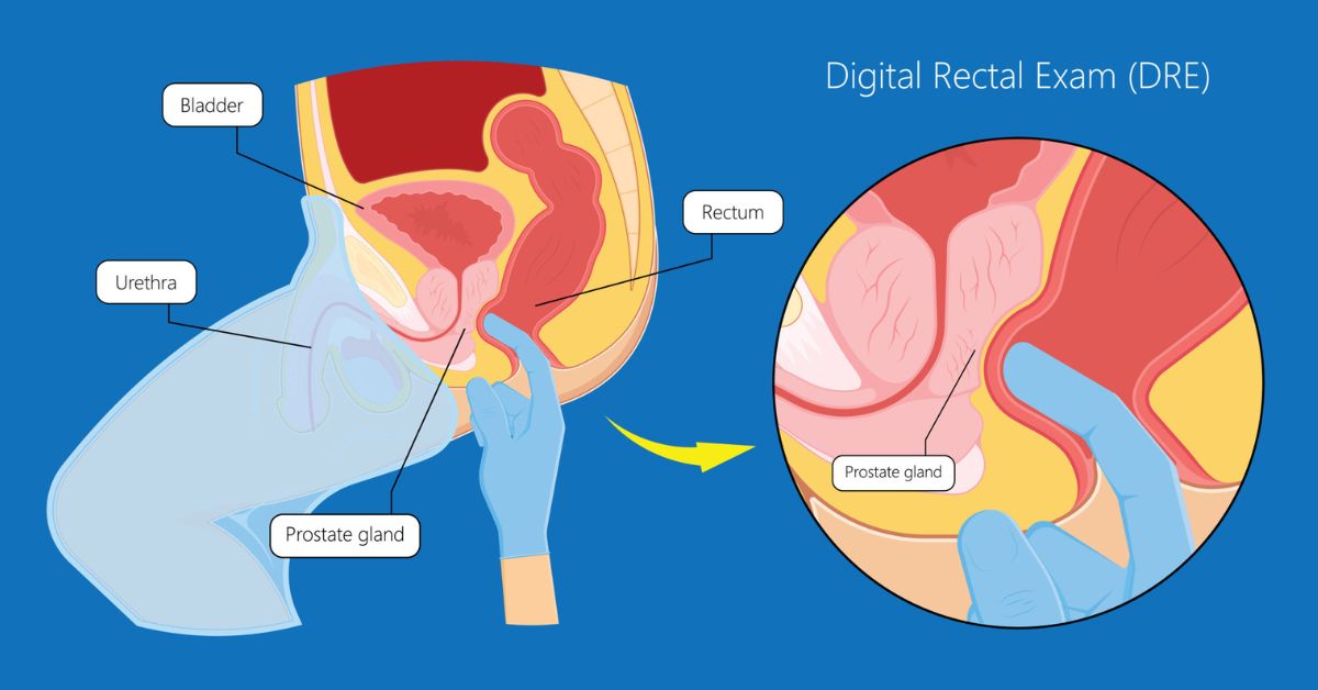 What is a Digital Rectal Exam – Everything You Need to Know