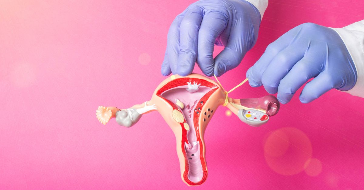 Tubectomy (Tubal Ligation) – Surgery, Procedure, Types & Recovery