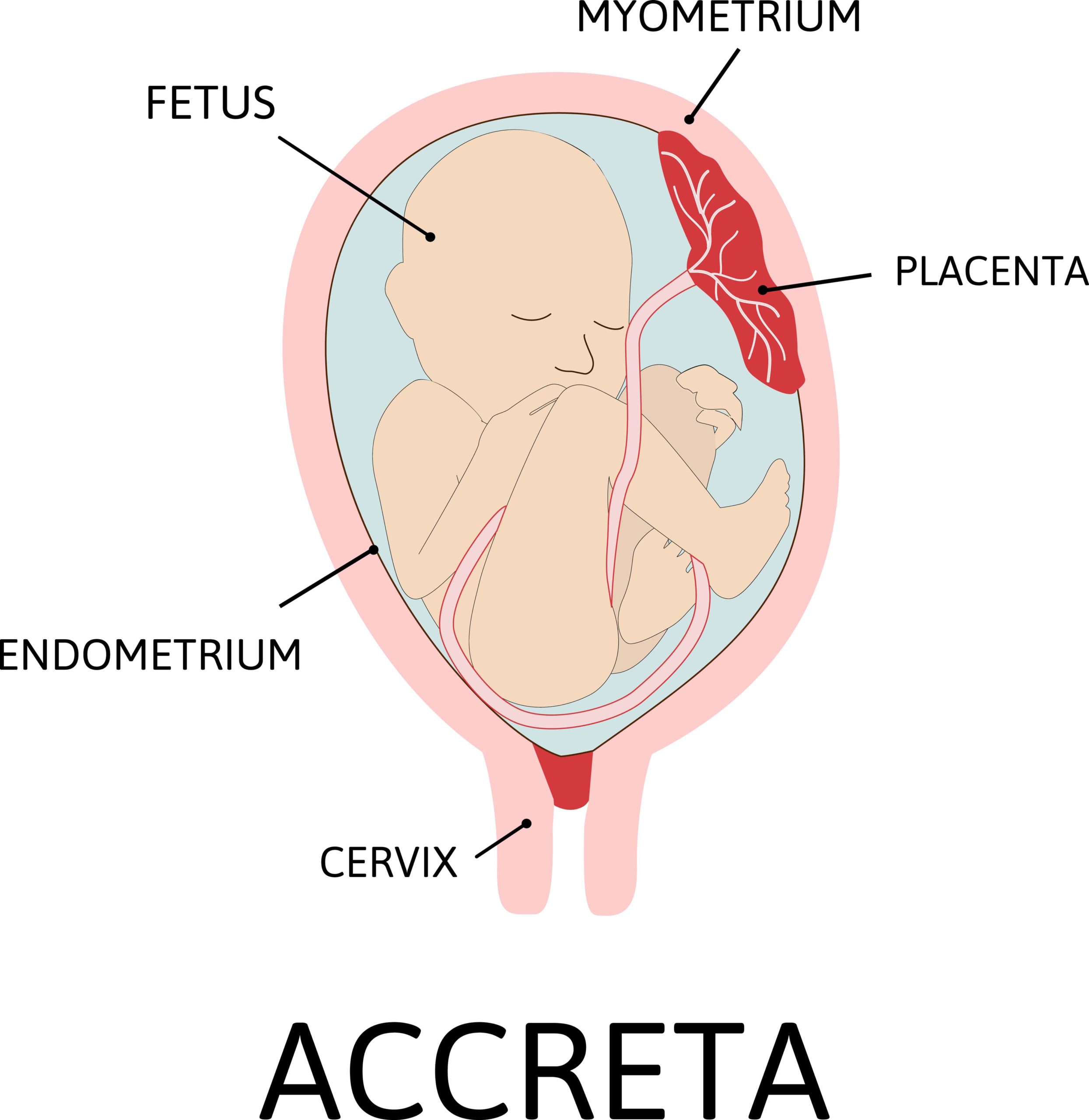 Placenta Accreta – Symptoms, Causes, Complications and Treatment