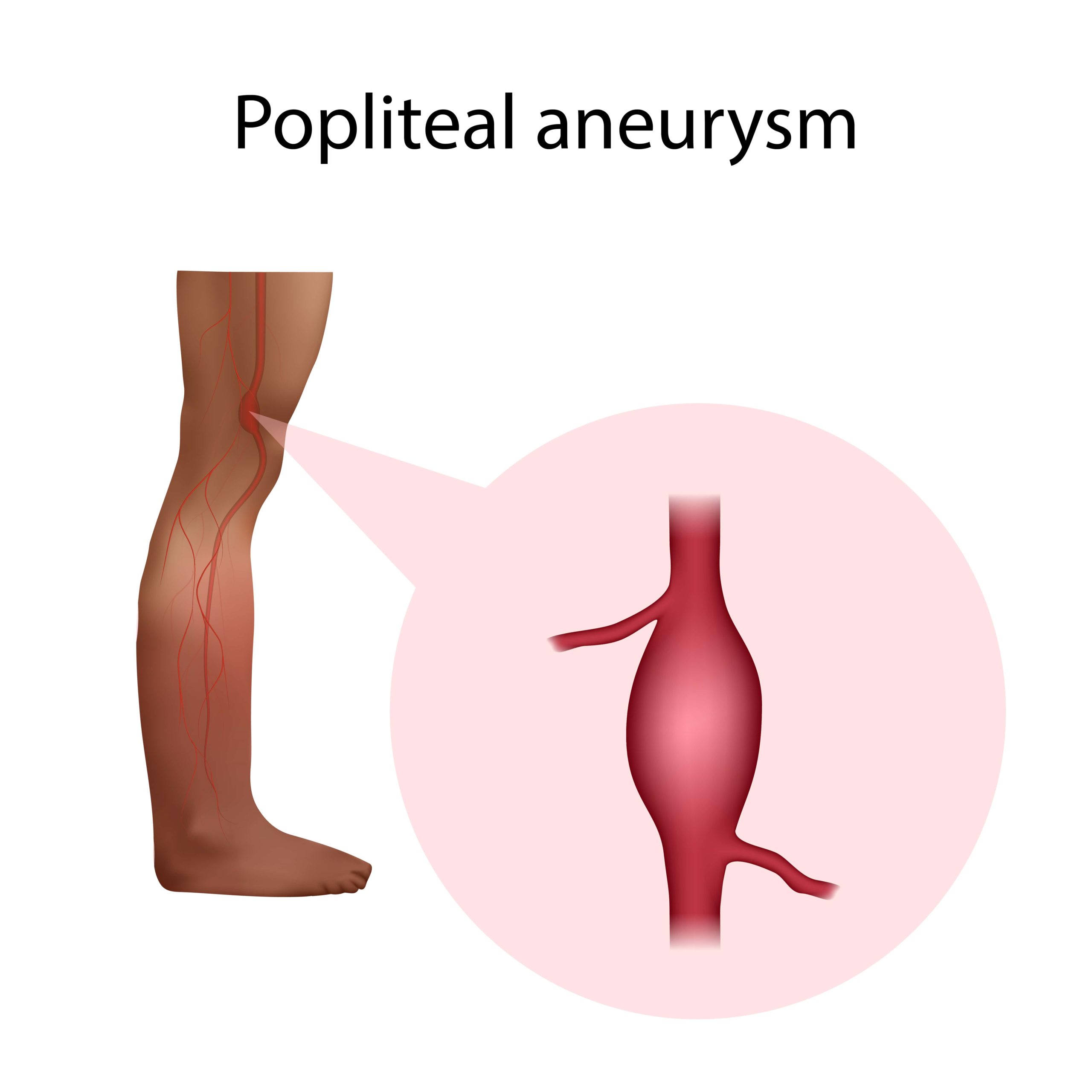 Popliteal Artery Aneurysm – Treatment and Symptoms