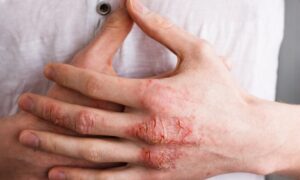 Hand Eczema – Symptoms, Causes, Types and Treatment