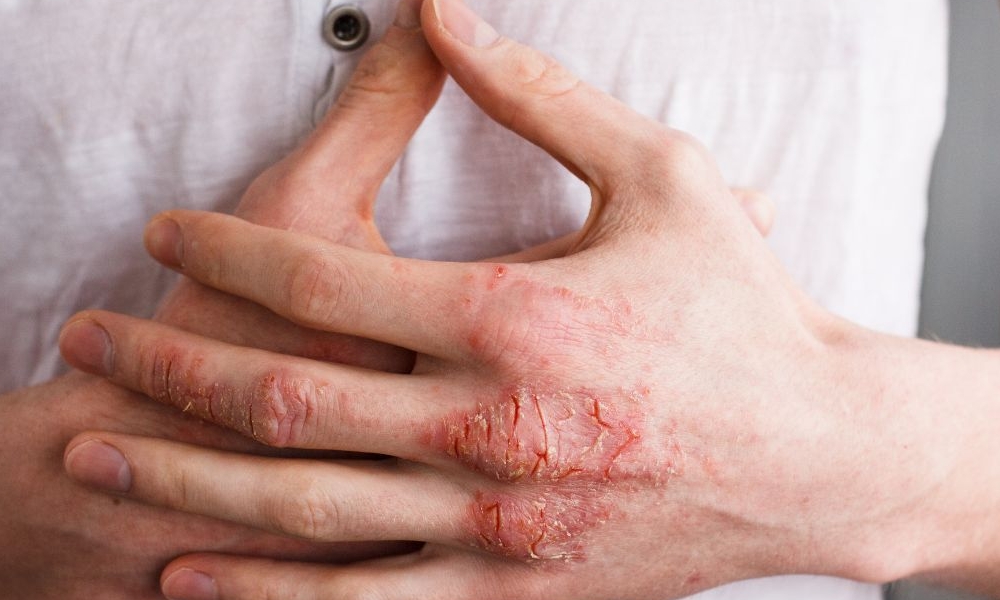 Hand Eczema – Symptoms, Causes, Types and Treatment