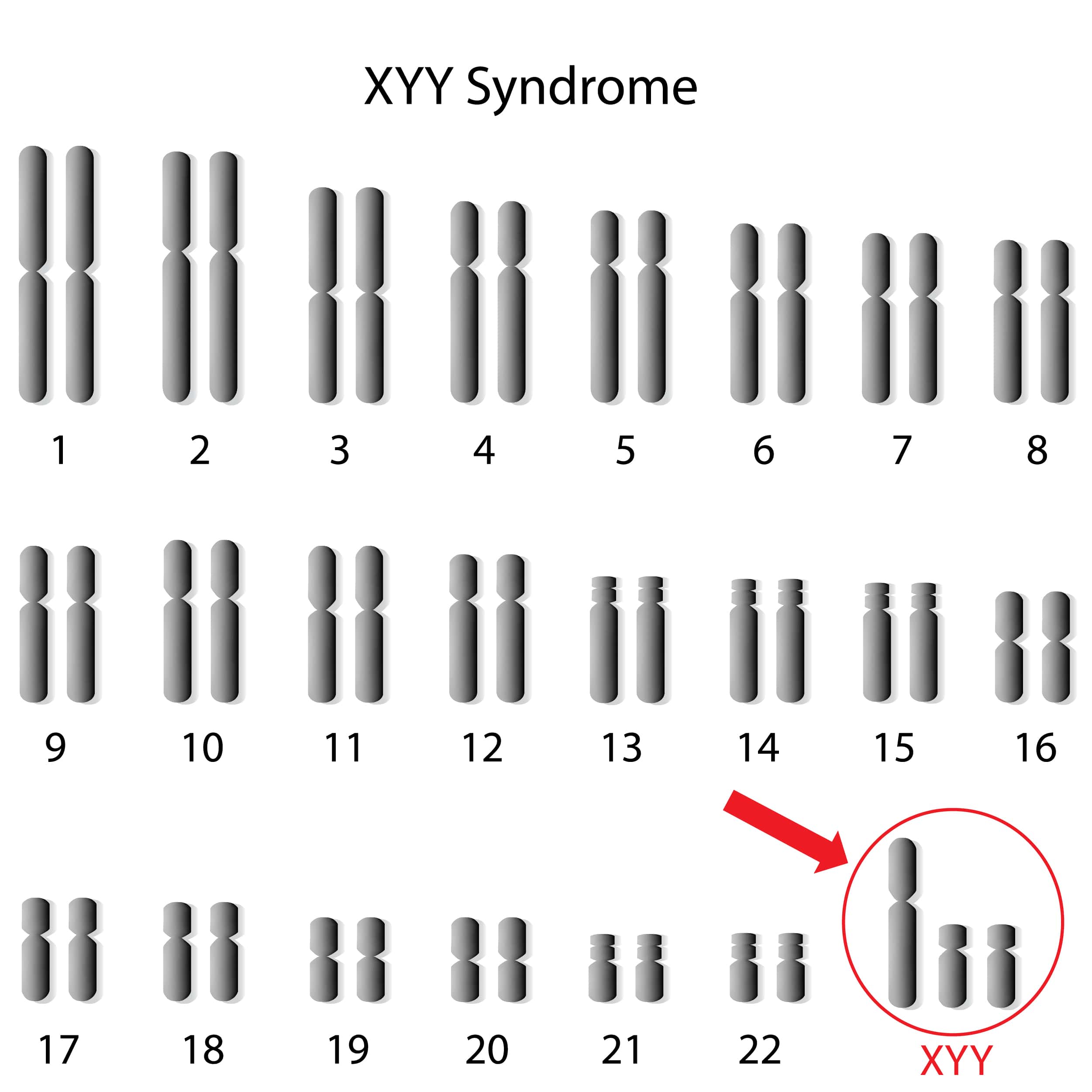 XYY Syndrome - Causes, Symptoms, Prevention and Treatment