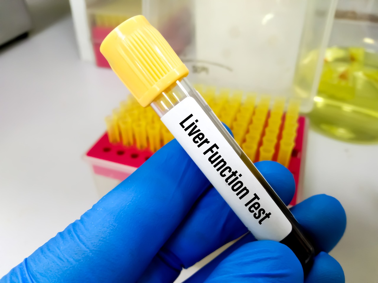 Liver Function Test (LFTs) – When is it done, Preparation and Procedure