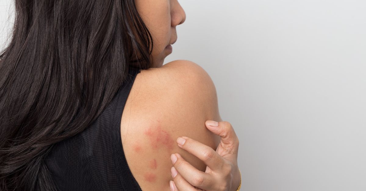 Aquagenic Urticaria : Symptoms, Causes, Treatment, Prevention and More