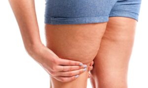 Methods of Treating Lipedema