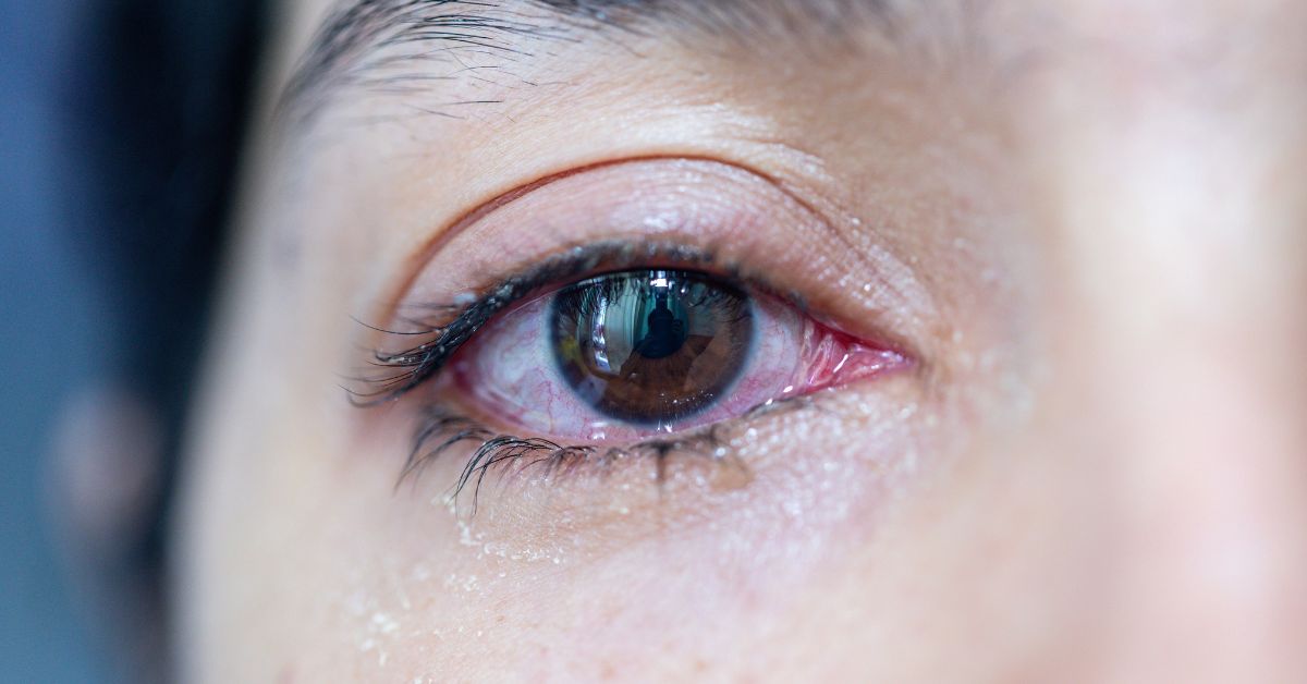 Watery Eyes (Epiphora): Causes, Symptoms, Treatments and Remedies