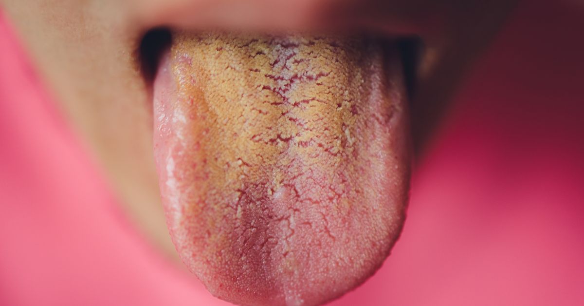 Yellow Tongue: Causes,  Symptoms, Treatment, Diagnosis and Prevention