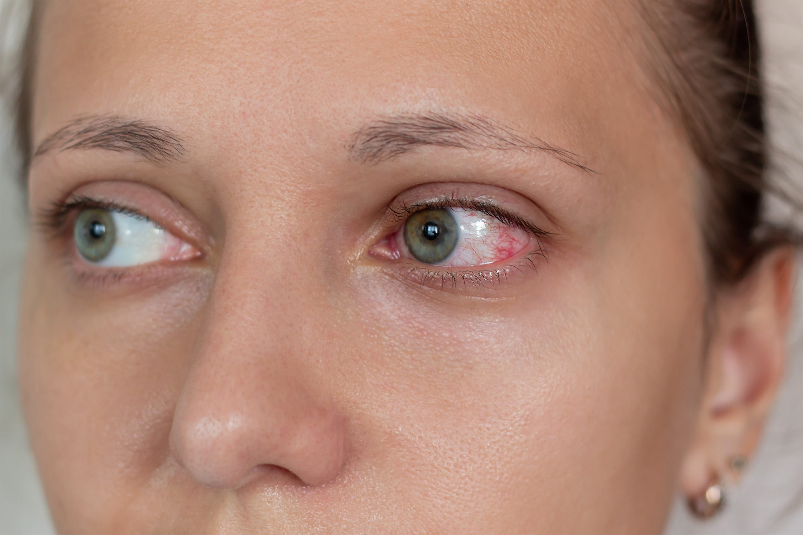 Uveitis : Types, Causes, Symptoms, Diagnosis and Treatment