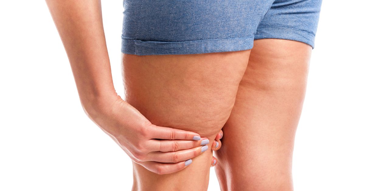 Methods of Treating Lipedema