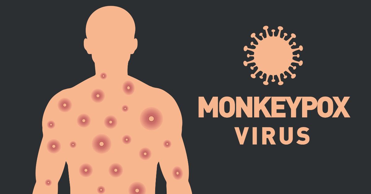 Monkeypox Symptoms: What to look for and how it spreads?