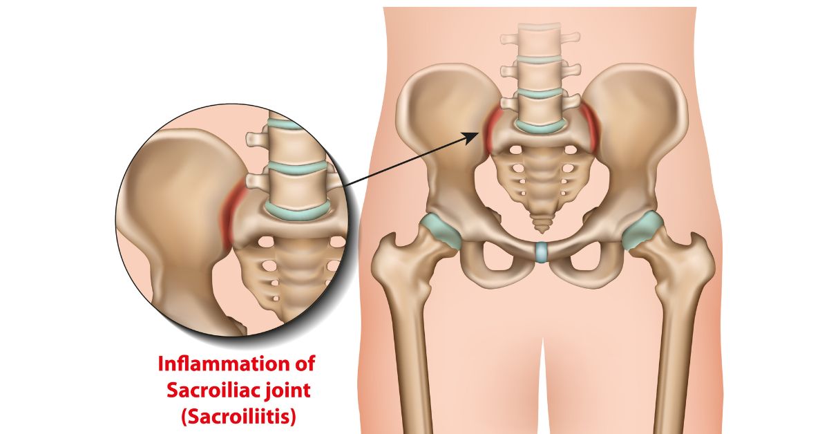 Sacroiliitis : Symptoms, Causes, Treatment, Home Remedies & Exercises