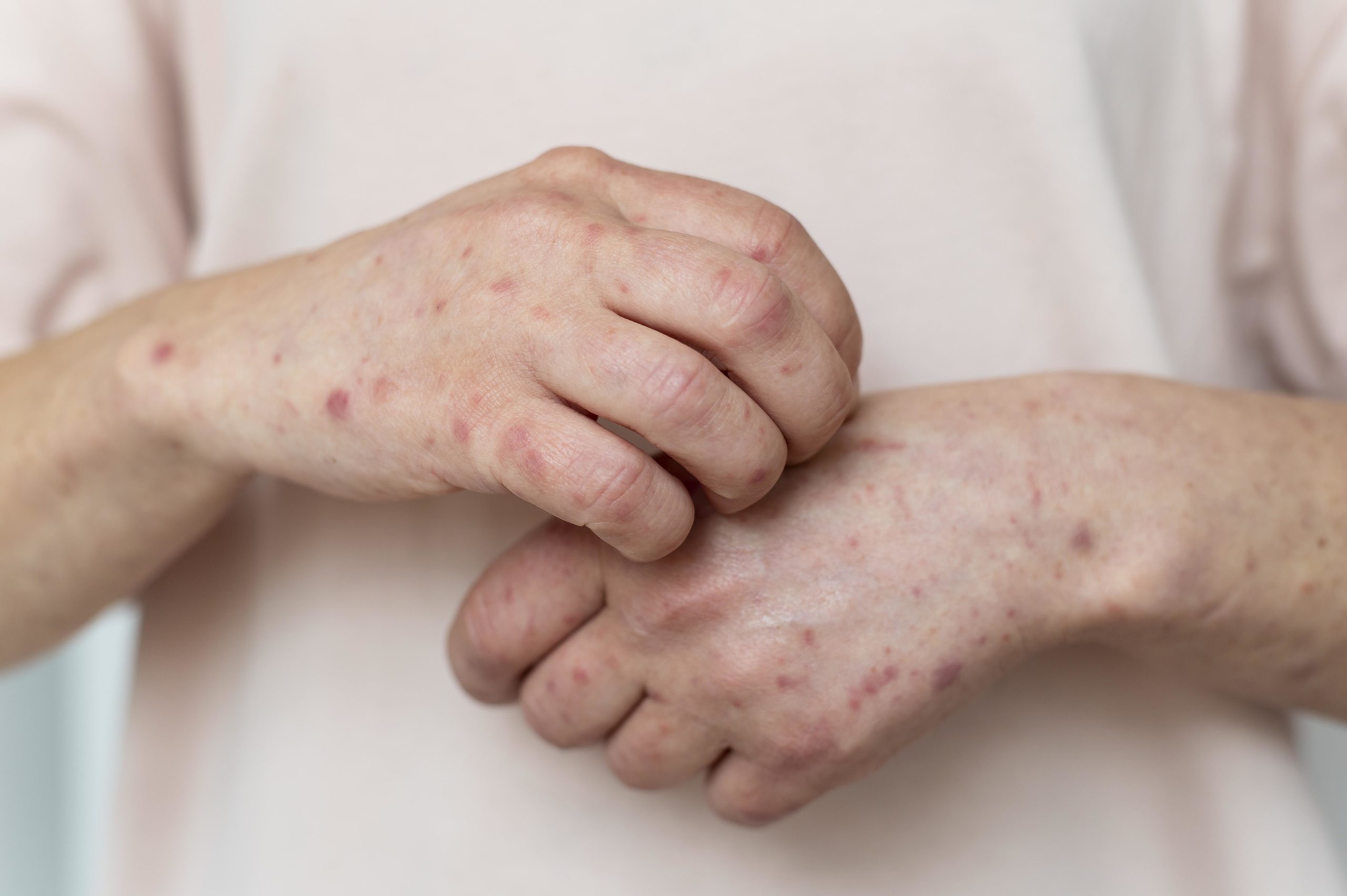 Actinic Keratosis (AK) : Causes, Symptoms and Treatment