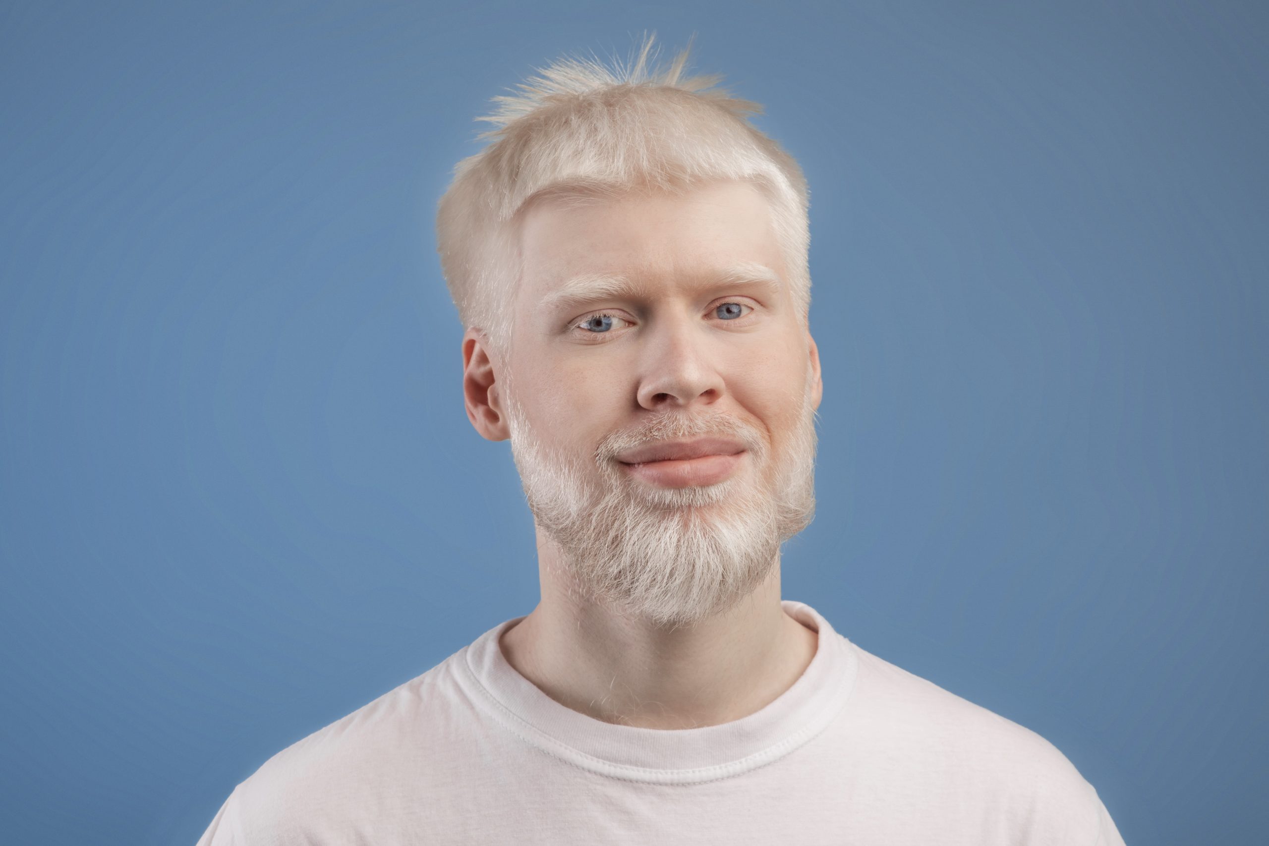 Albinism: Types, Causes, Symptoms  and Treatment