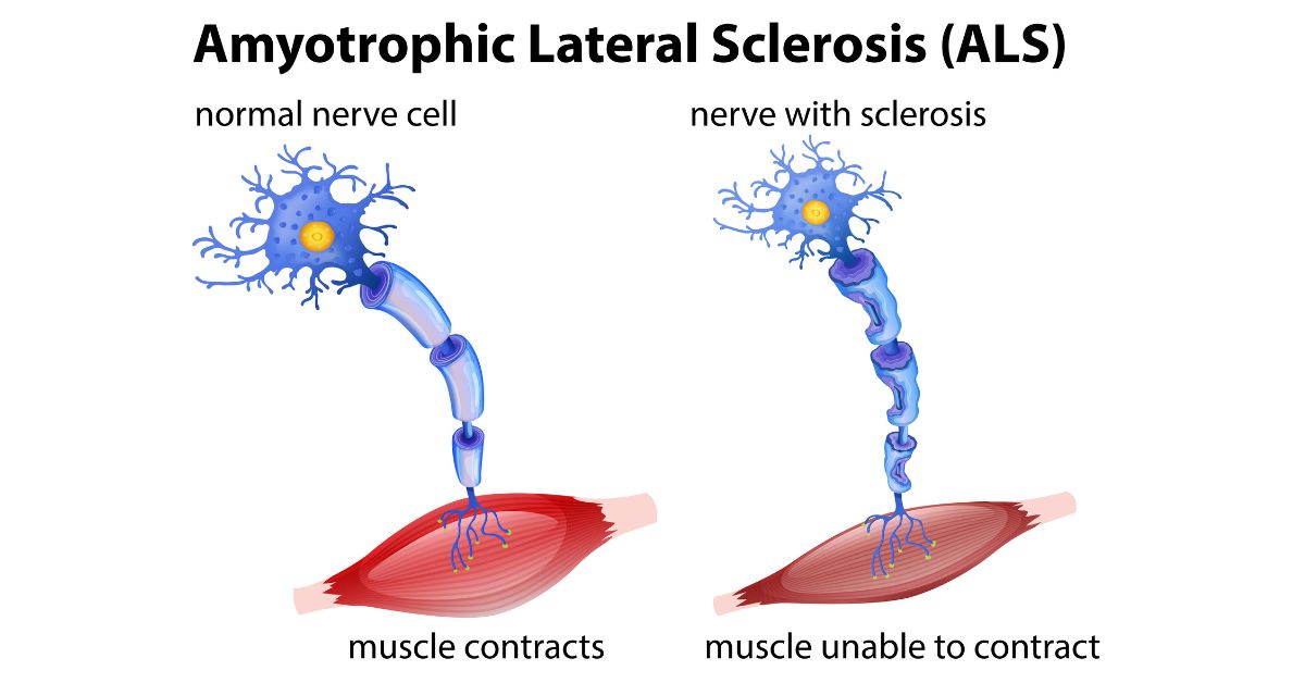 Amyotrophic Lateral Sclerosis (ALS): Causes, Symptoms and Treatment