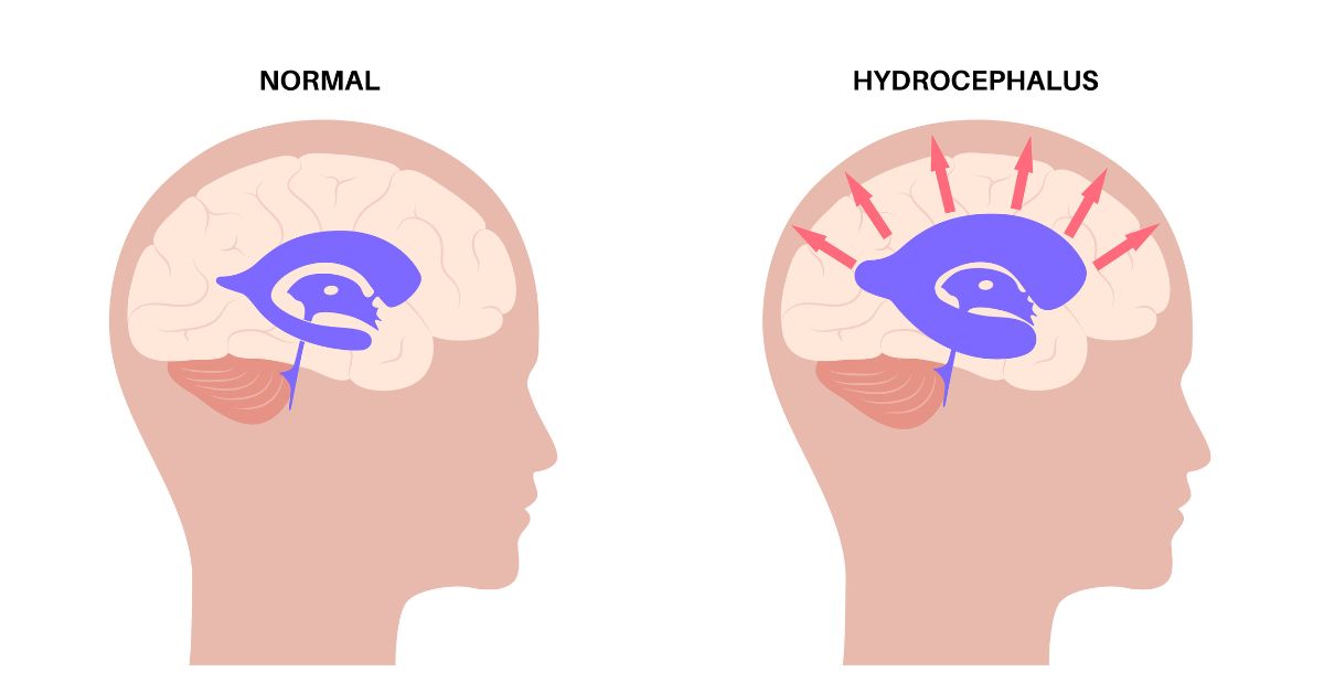 Ventriculoperitoneal or VP Shunt: Types, Procedure, Surgery & Recovery