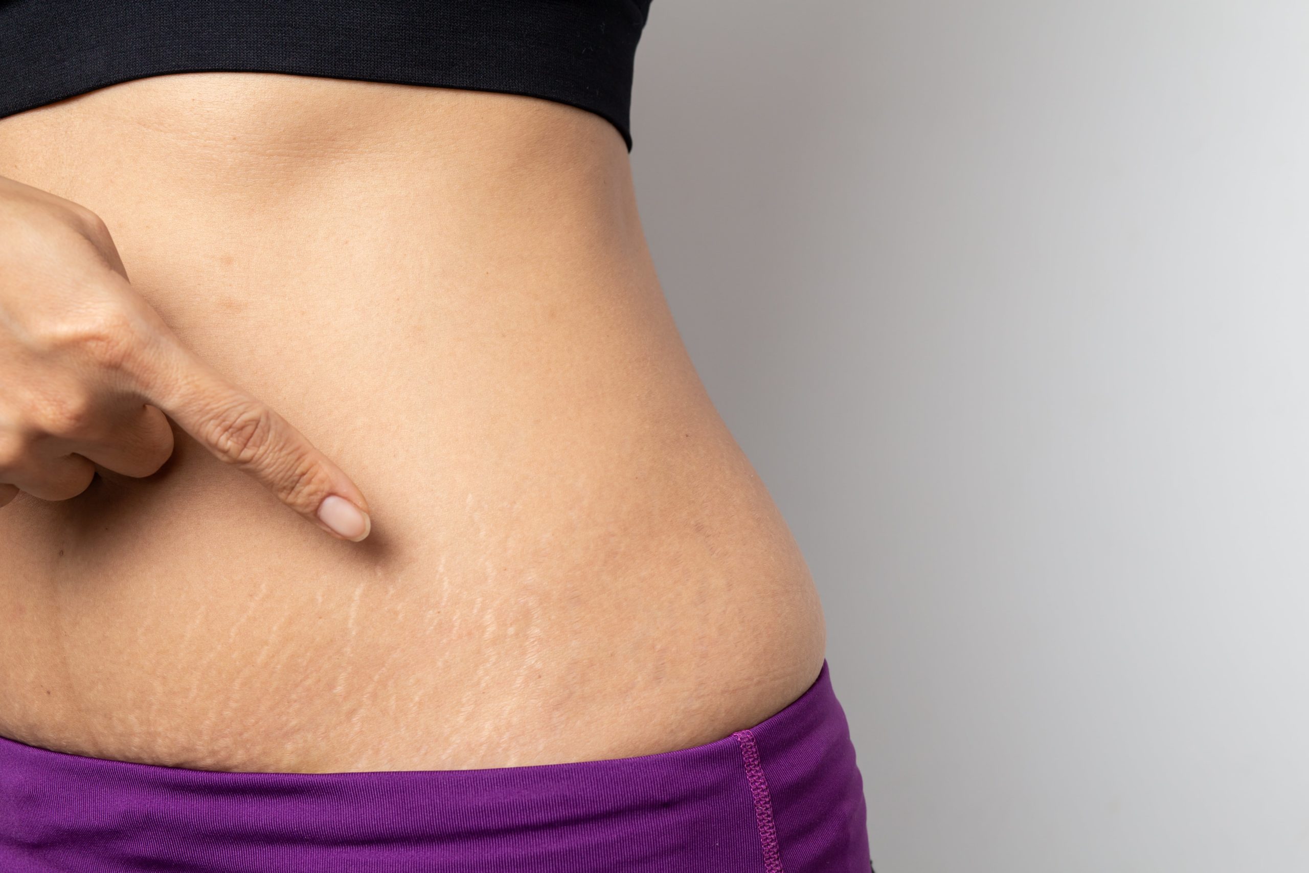 Pregnancy Stretch Marks: During and After Pregnancy, and What to Expect