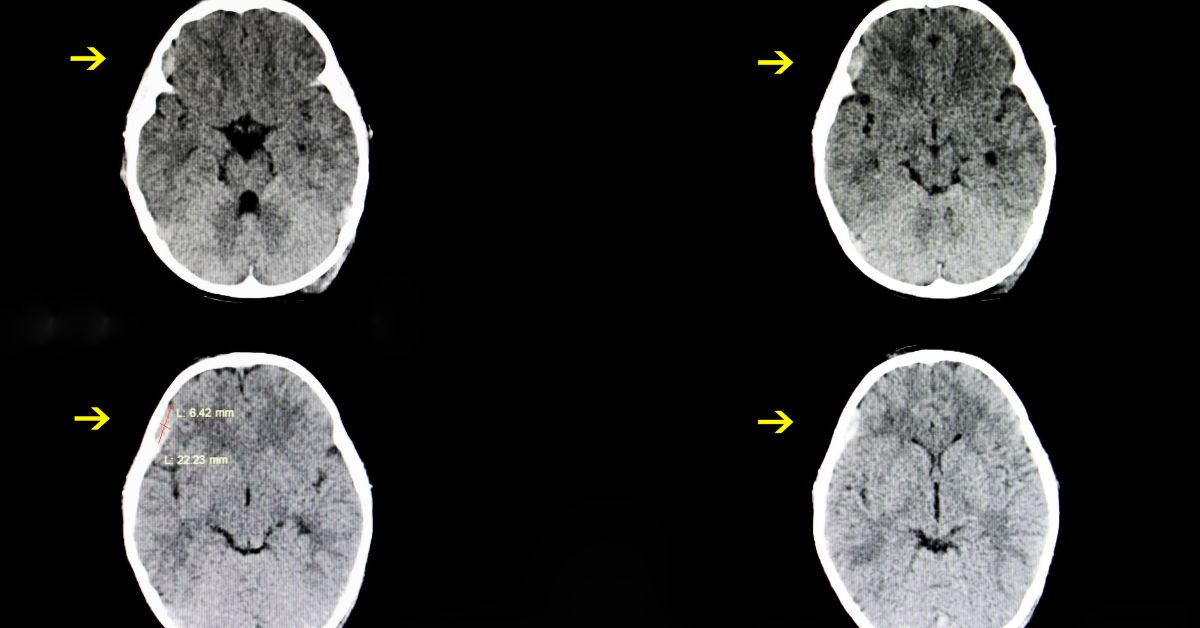 Subdural Hematoma: Types, Symptoms, Causes, Treatment - Apollo Hospitals