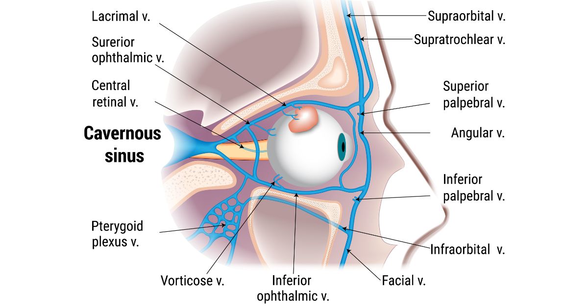 Cavernous Sinus Thrombosis: Symptoms, Causes and Treatment