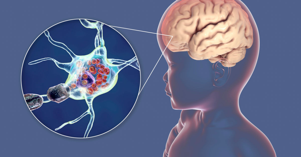 Lysosomal Storage Diseases : Types, Causes, Symptoms, Diagnosis and reatment