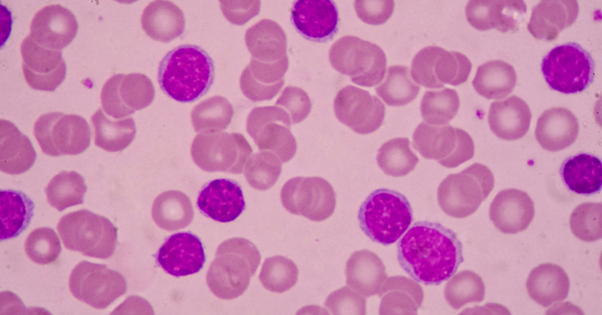 Acute Myelogenous Leukemia (AML): Symptoms, Causes and Treatment