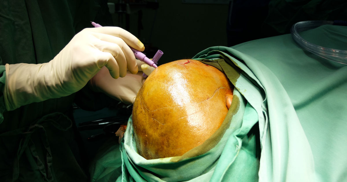 Craniectomy: Definition, Procedure, Risks and Recovery Time