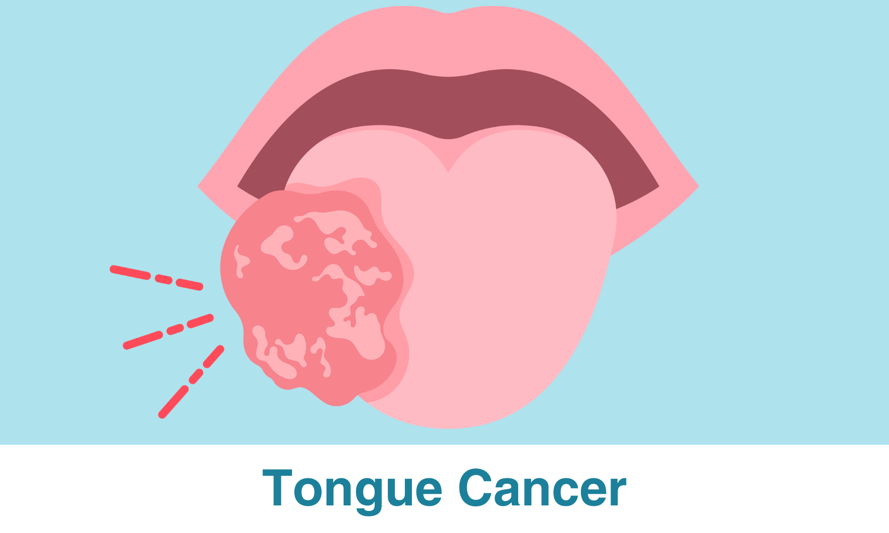 Spotting the Signs: Early Detection of Tongue Cancer - Apollo Hospitals ...