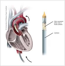 1st Percutaneous Tavi (Trans Cathter Aortic Valve Implantation)