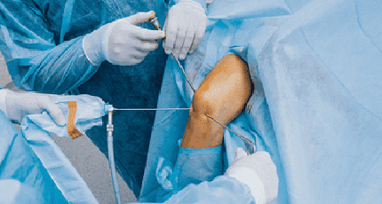 Arthroscopy