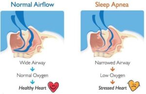 Normal Airflow and Sleep Apnea