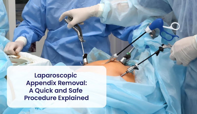 Extirpación laparoscópica del apéndice: un procedimiento rápido y seguro explicado
