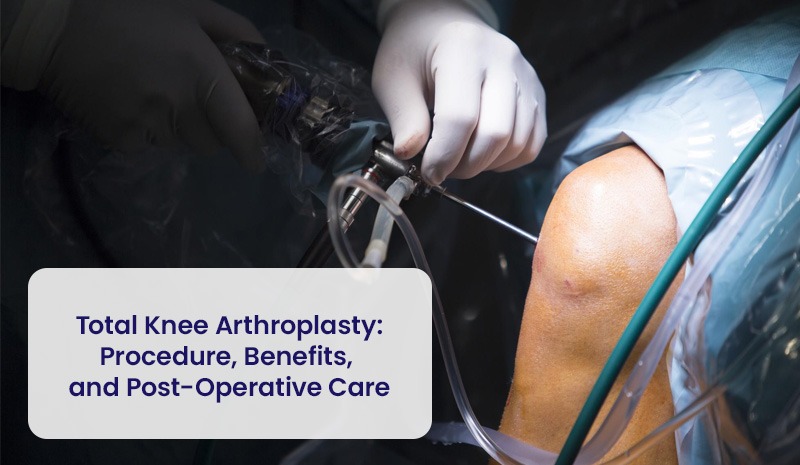 Artroplastia total de rodilla: procedimiento, beneficios y cuidados postoperatorios